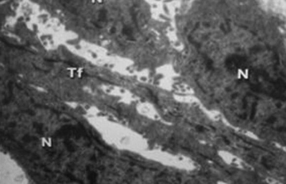 Transmission Electron Microscopy of Ameloblastoma: A Study on Six Cases