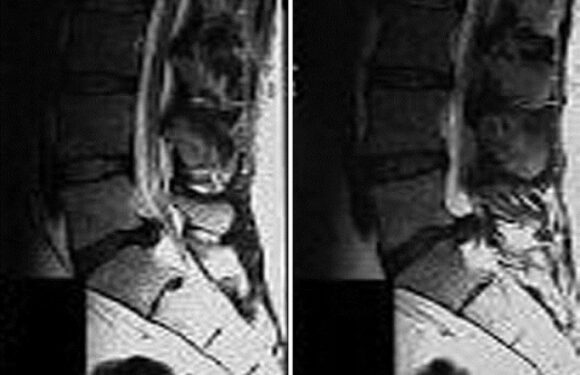 Outcome of Nucleoplasty in Patients with Radicular Pain Due to Lumbar Intervertebral Disc Herniation