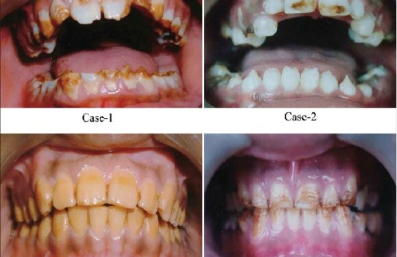 Amelogenesis imperfecta: Four case reports