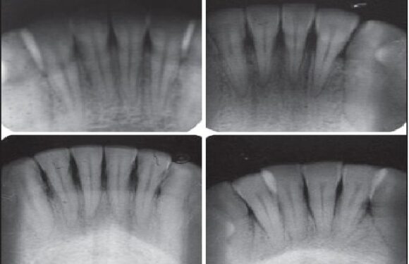 Incidence of nutrient canals in hypertensive patients: A radiographic study