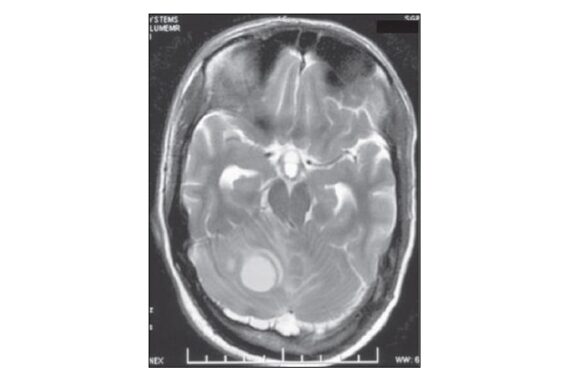 Tuberculous brain abscess in an immunocompetent adolescent