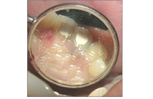 Management of palato radicular groove in a maxillary lateral incisor