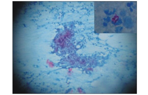 Primary tubercular mastitis masquerading as malignancy