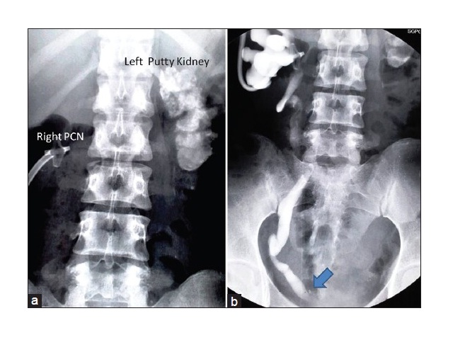 Delivery after augmentation cystoplasty: Implications and precautions ...