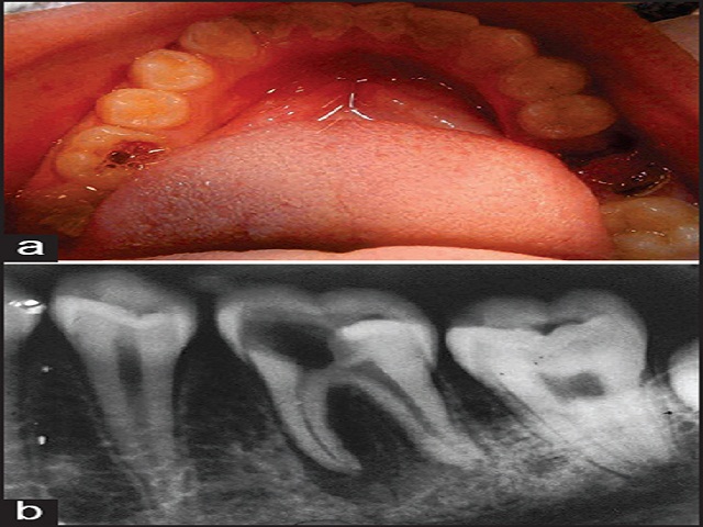 Tooth Hemisection Hemisection: A conservative management of periodontally involved molar ...
